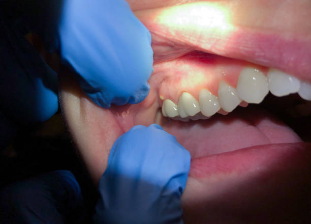 Best Emergency Treatment for Toothache in Junction, TX