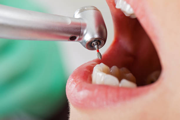 Best Emergency Tooth Extraction in Junction, TX